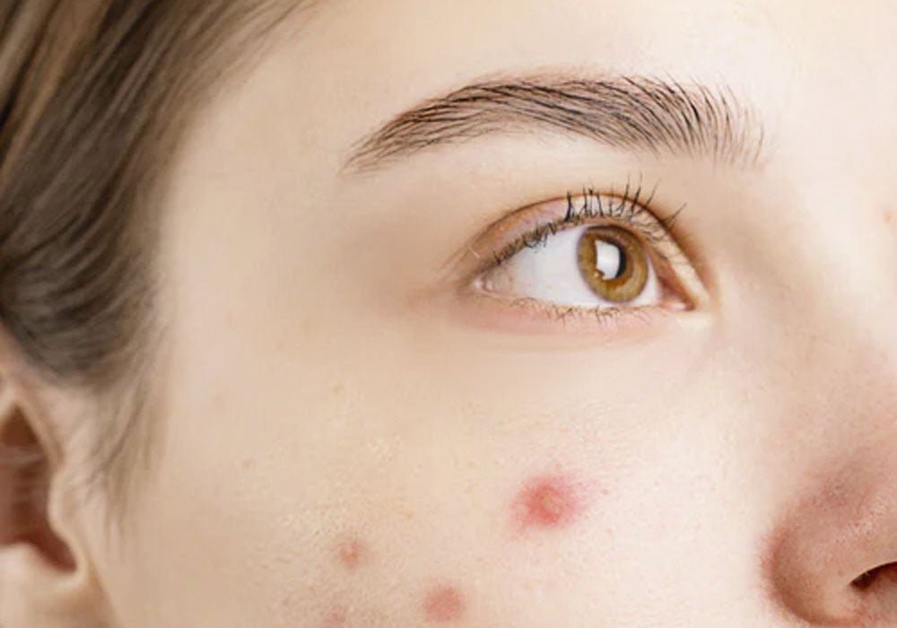 Behandlungsmöglichkeiten bei hormonell bedingter Akne