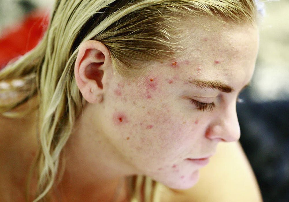 Chronische Hauterkrankungen