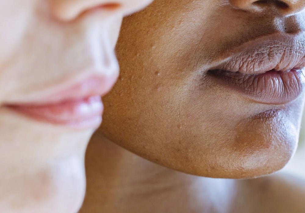 Fettige Haut im Gesicht – So wird man sie los!