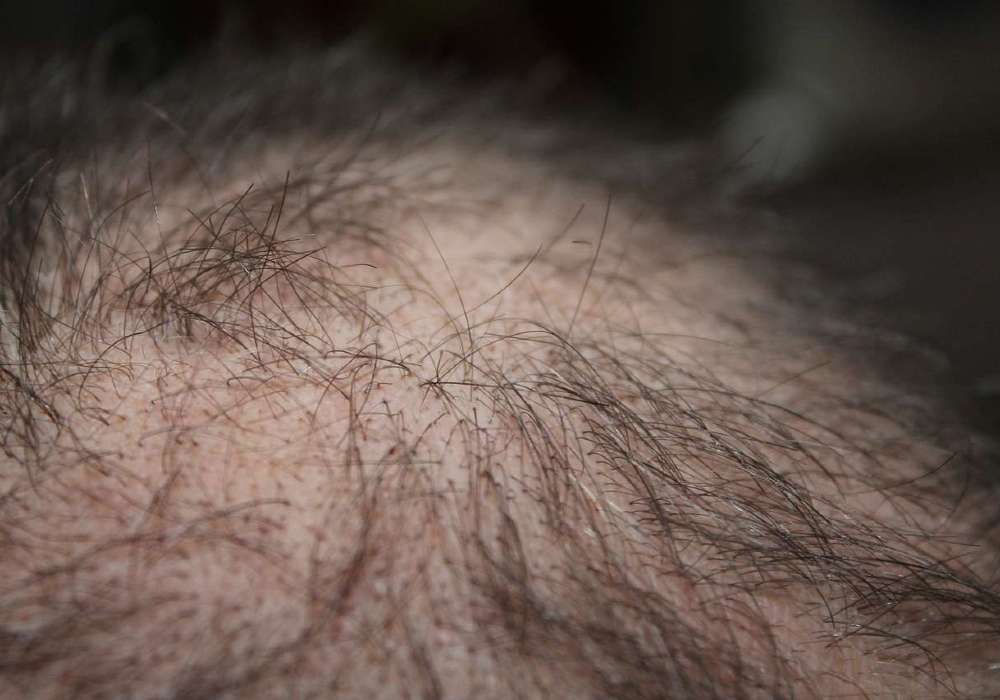 Von Strähne zu Strähne: Strategien zur Bekämpfung von Haarausfall